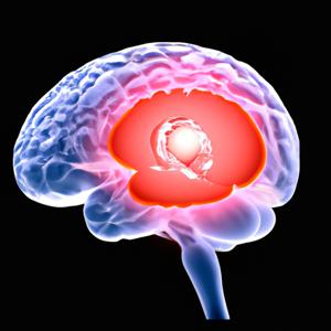 지나치기 쉬운 '뇌종양' - 6가지 초기 증상과 예방법 및 추천식단